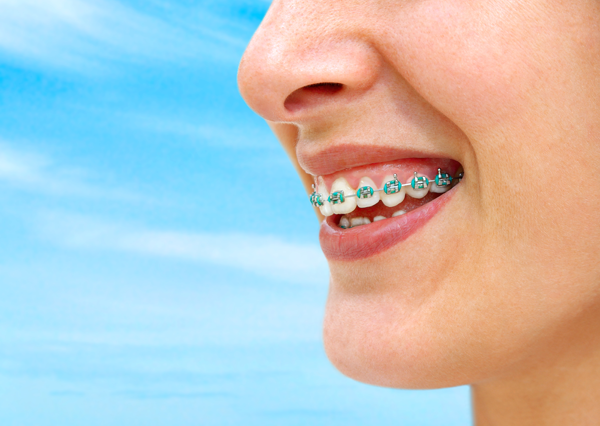 braces-in-ventura-county-ca