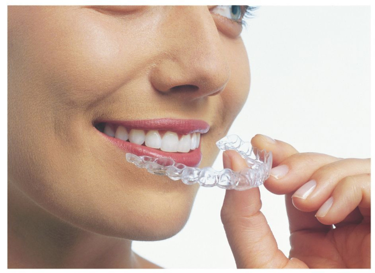 Invisalign aligner oxnard