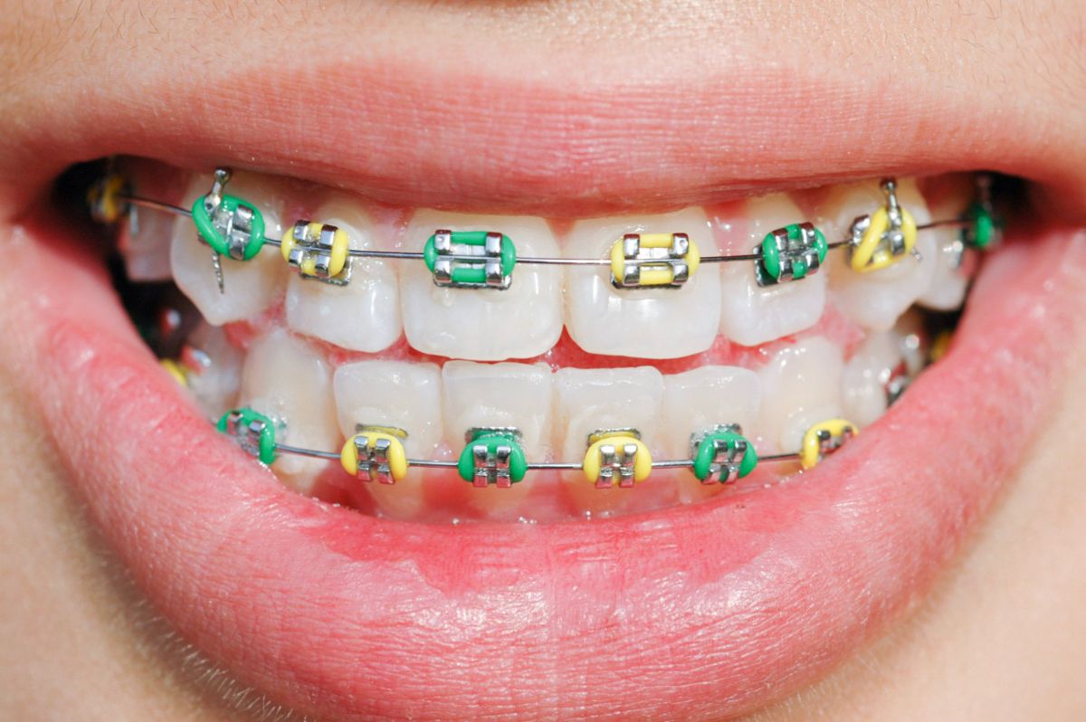 10 Braces Myths You Need to Know